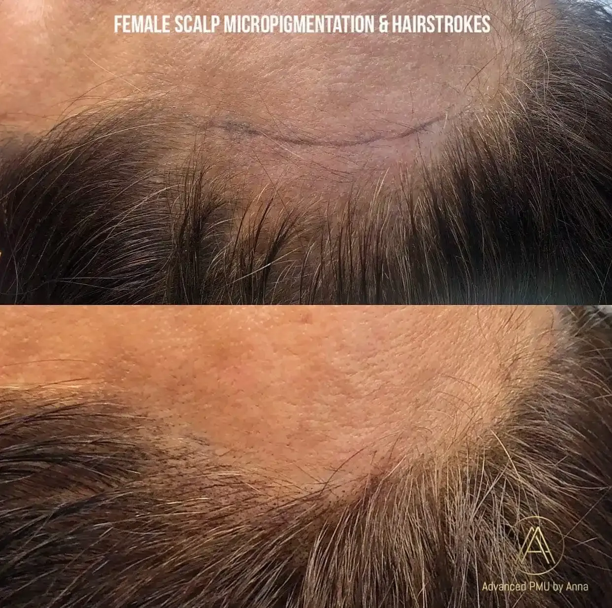 Scalp Micropigmentation Training & Certification in LA, NY, and Seoul