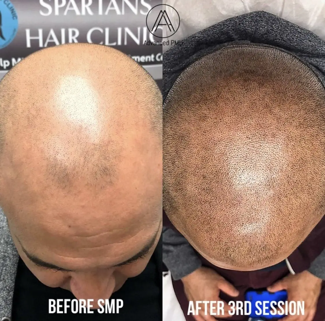 Male Scalp Micropigmentation, Before & After